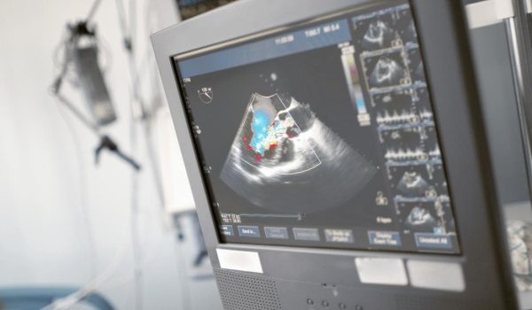 a-screen-showing-an-echocardiogram
