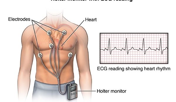 Anterior view male figure torso with holter monitor and ekg/heart rhythm inset; ACardio_20140402_v0_005

SOURCE: cardio_holter-monitor_proc_1_layers.psd